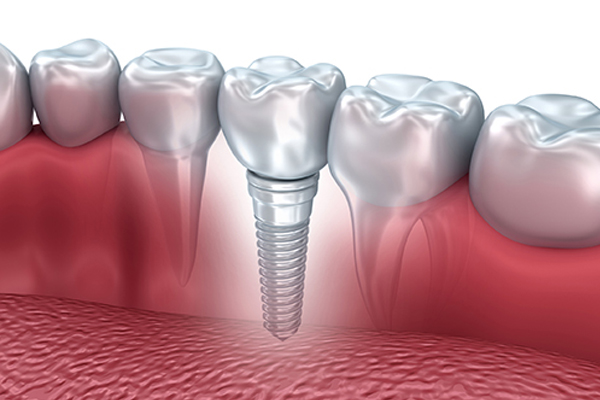 affordable-dental-implants-amazing-smile-dental-NY