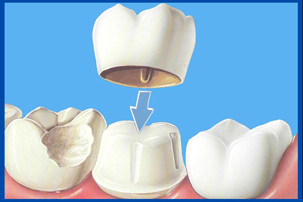 crowns-dentist-11375-amazing-smile-dental-ny