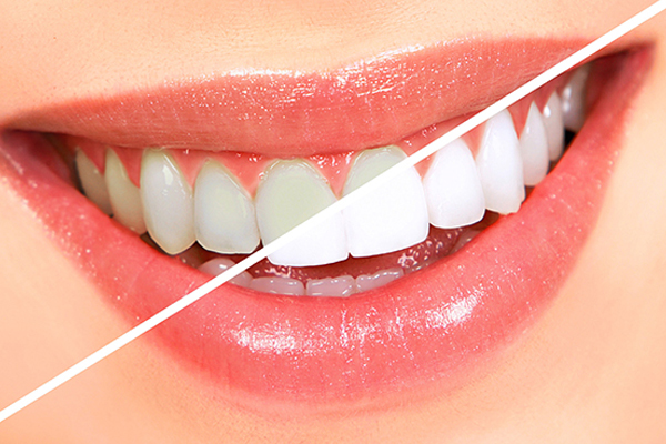 top-teeth-whitening-dentist-amazing-smile-dental-ny